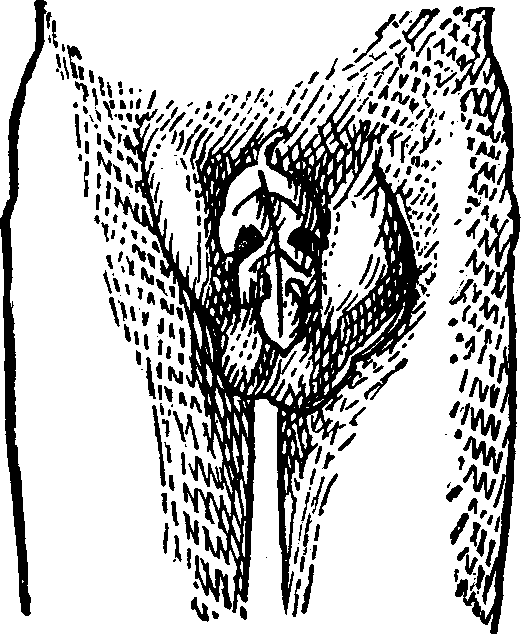 Illustration:
Fig. 5.  This figure illustrates a Double Inguinal Hernia