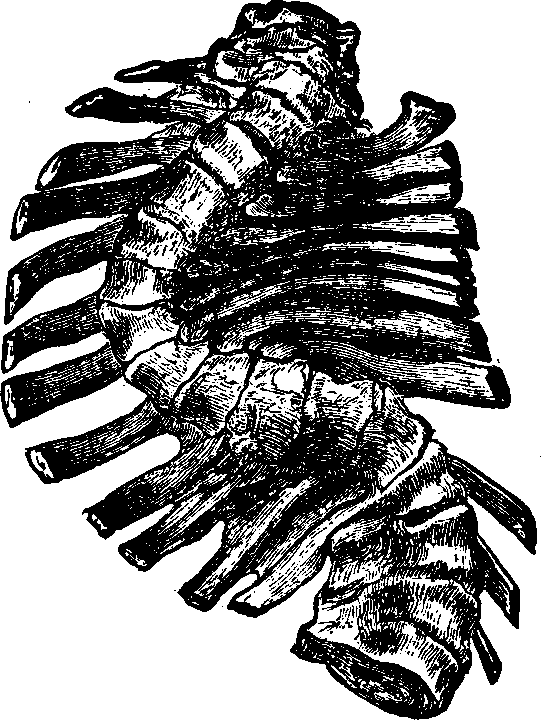 Illustration:
Fig. 8. Lateral curvature in an advanced stage. 