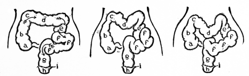 Image unavailable: Normal colon. Arrows show course of fecal matter.

Abnormal colon contracted and bent into curves by pressure of corset.

Abnormal colon prolapsed. This condition may result from general low
vitality or from corset pressure.
a, caecum. b, ascending colon. c, hepatic flexure. d, transverse colon.
e, descending colon. f, f, f, sigmoid flexure. g, rectum. h, anus. i,
sphincter ani.