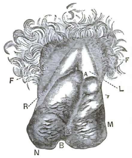 Pachydermatous tumor